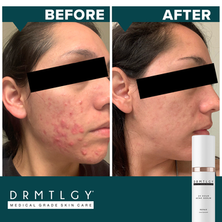 24 Hr Acne Serum