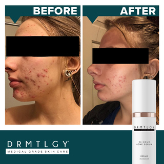 24 Hr Acne Serum